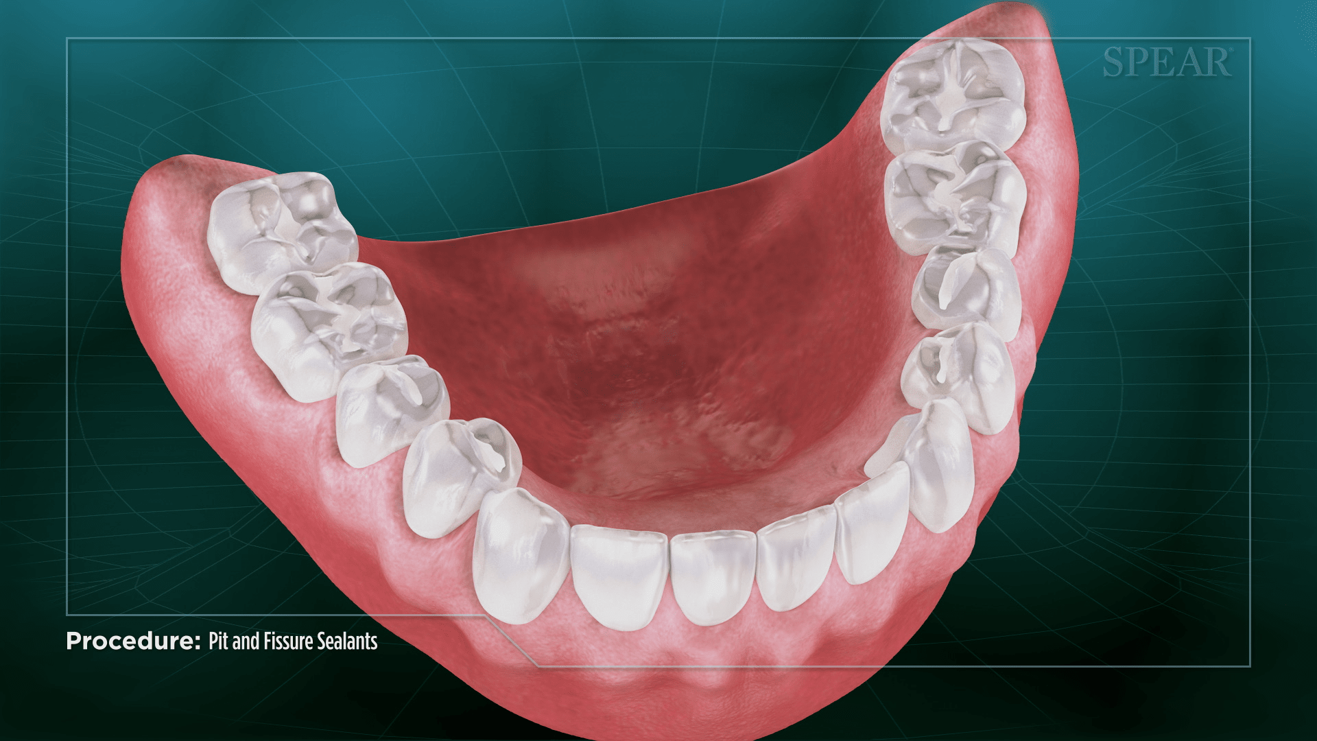 Teeth Groove Sealing at SmileMore Dental