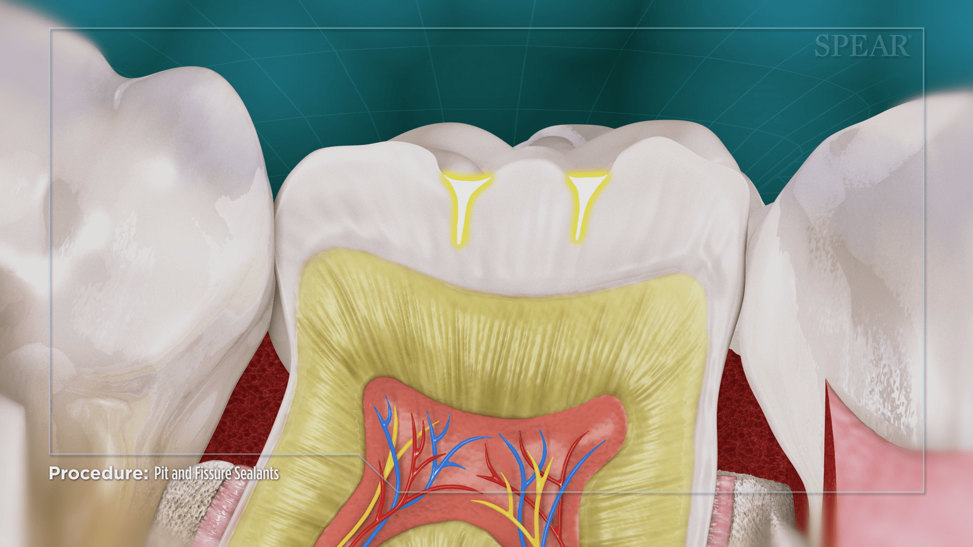 Molar and Premolar Surface Sealants at SmileMore Dental