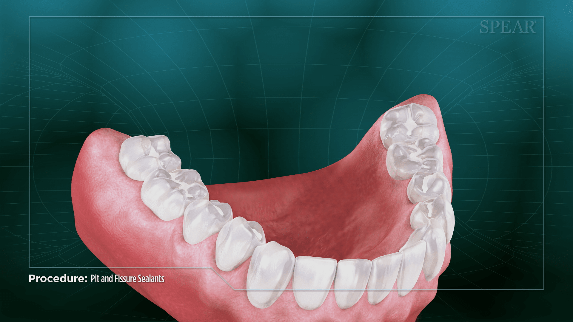 Sealant Application at SmileMore Dental