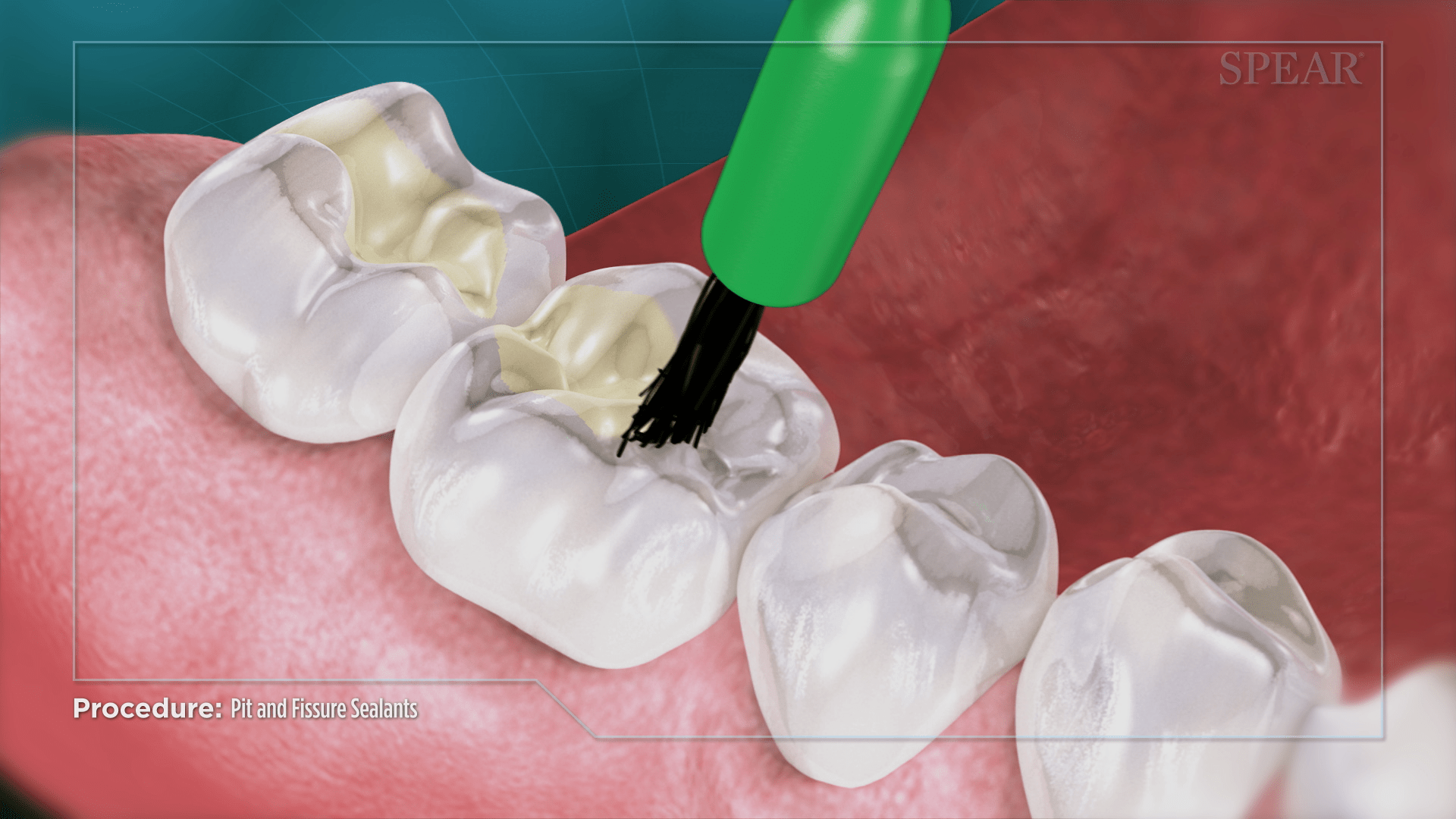 Pre-Sealant Tooth Cleaning at SmileMore Dental