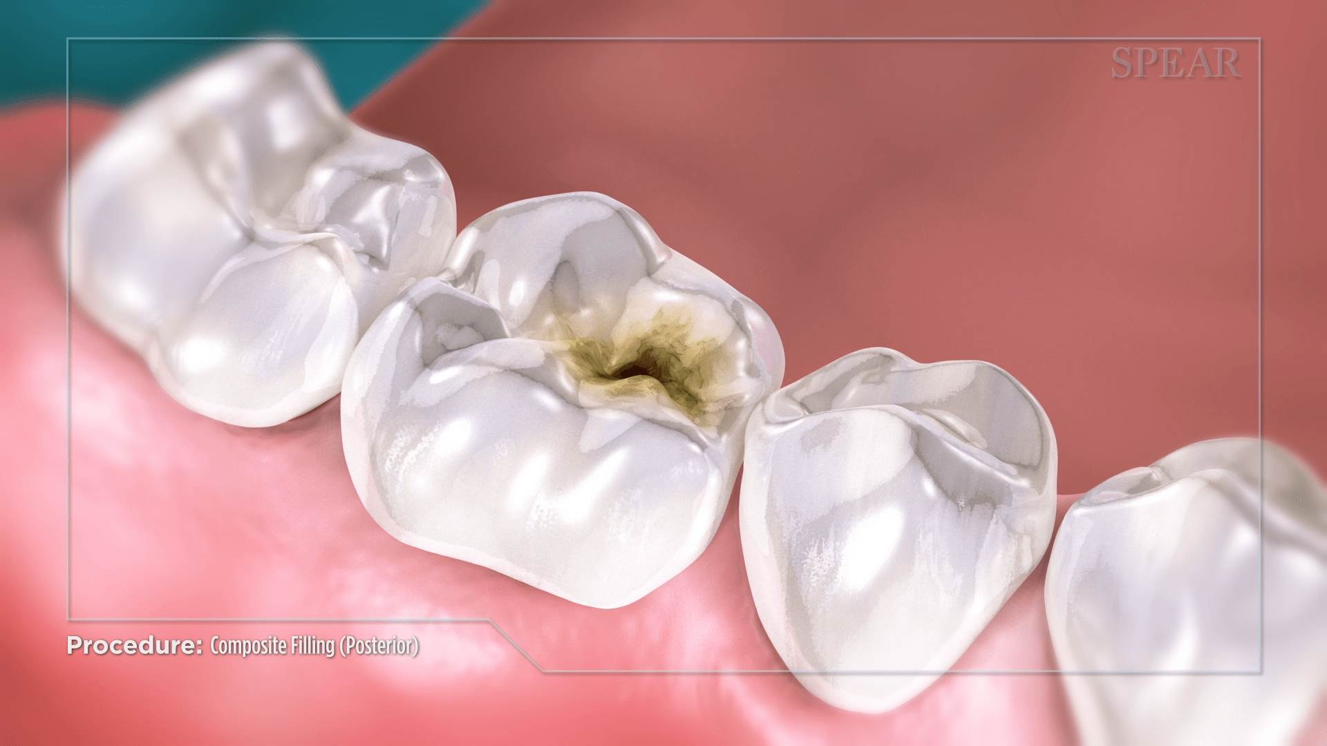Tooth Cavity Repair in Oro Valley