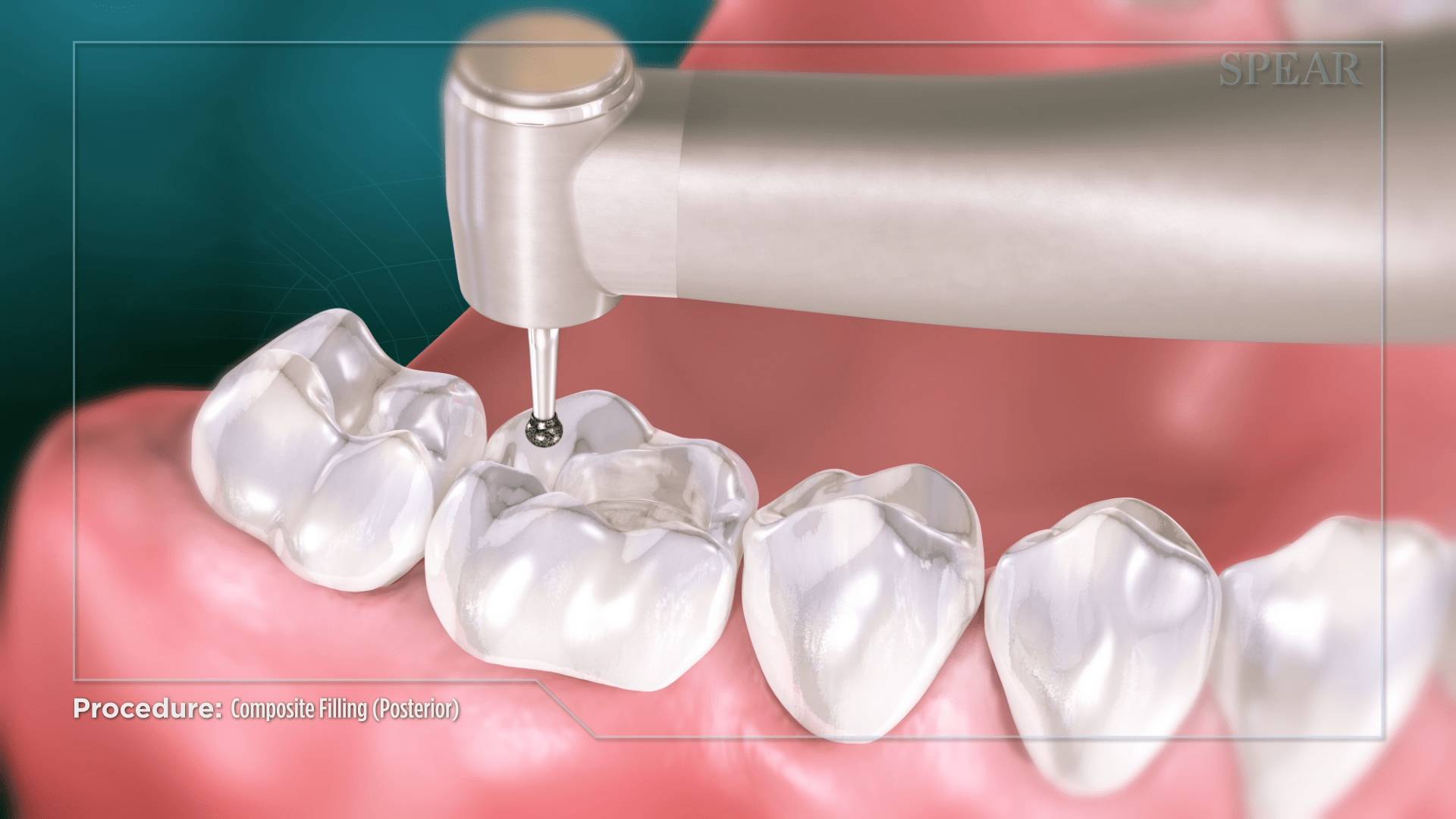Decayed Portion Removal at SmileMore Dental