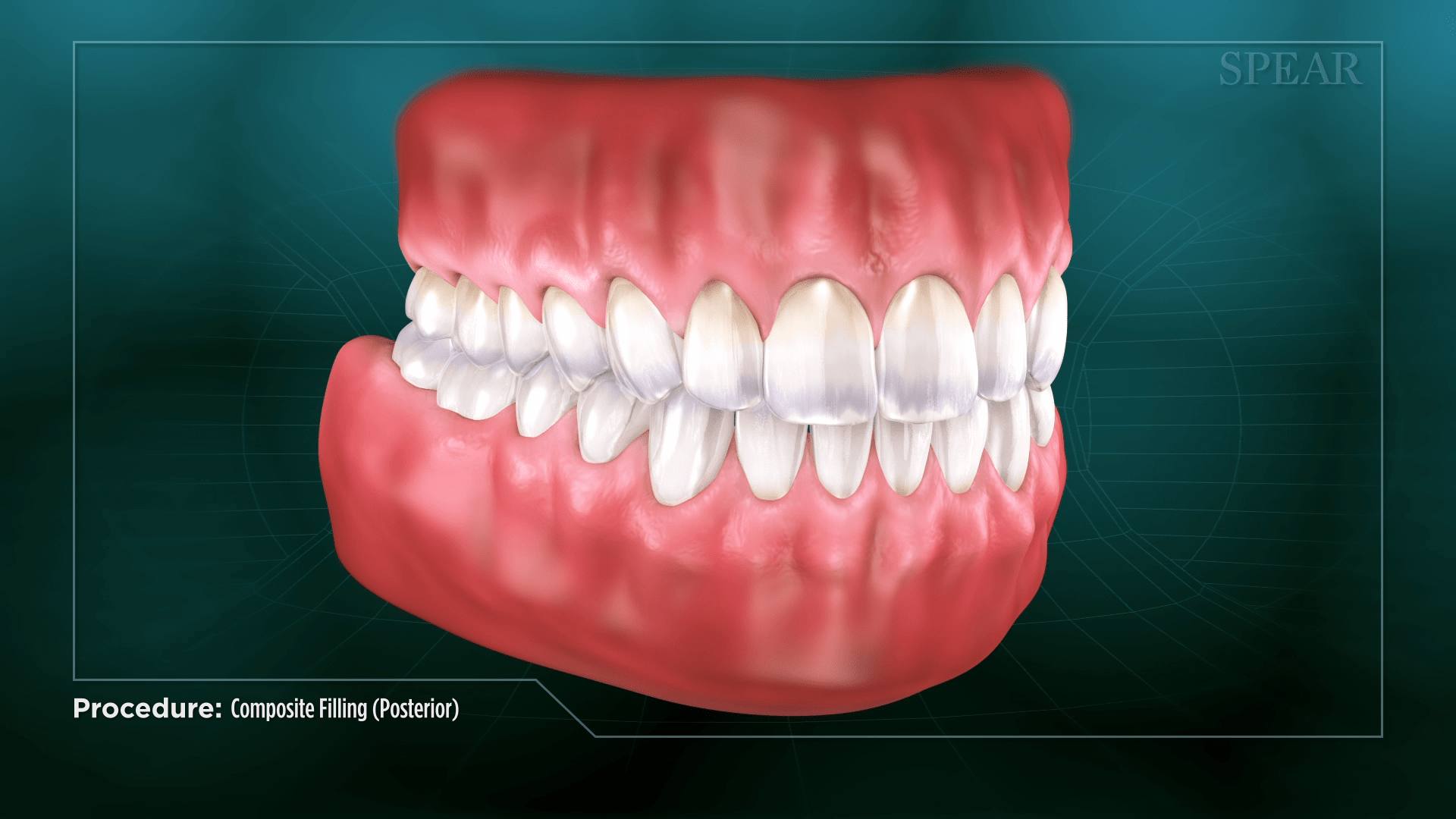 Composite Filled Teeth at SmileMore Dental