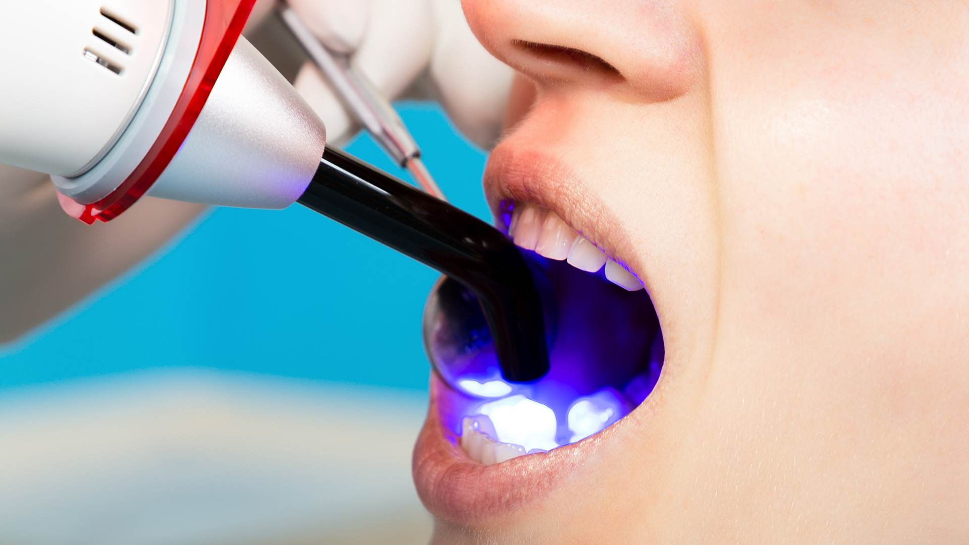 Teeth Bonding Service in Oro Valley