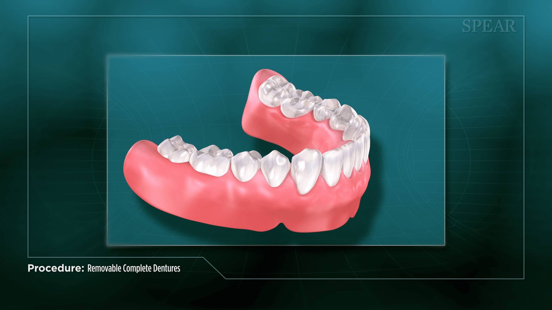 Removable Denture Fitting in Oro Valley, IL