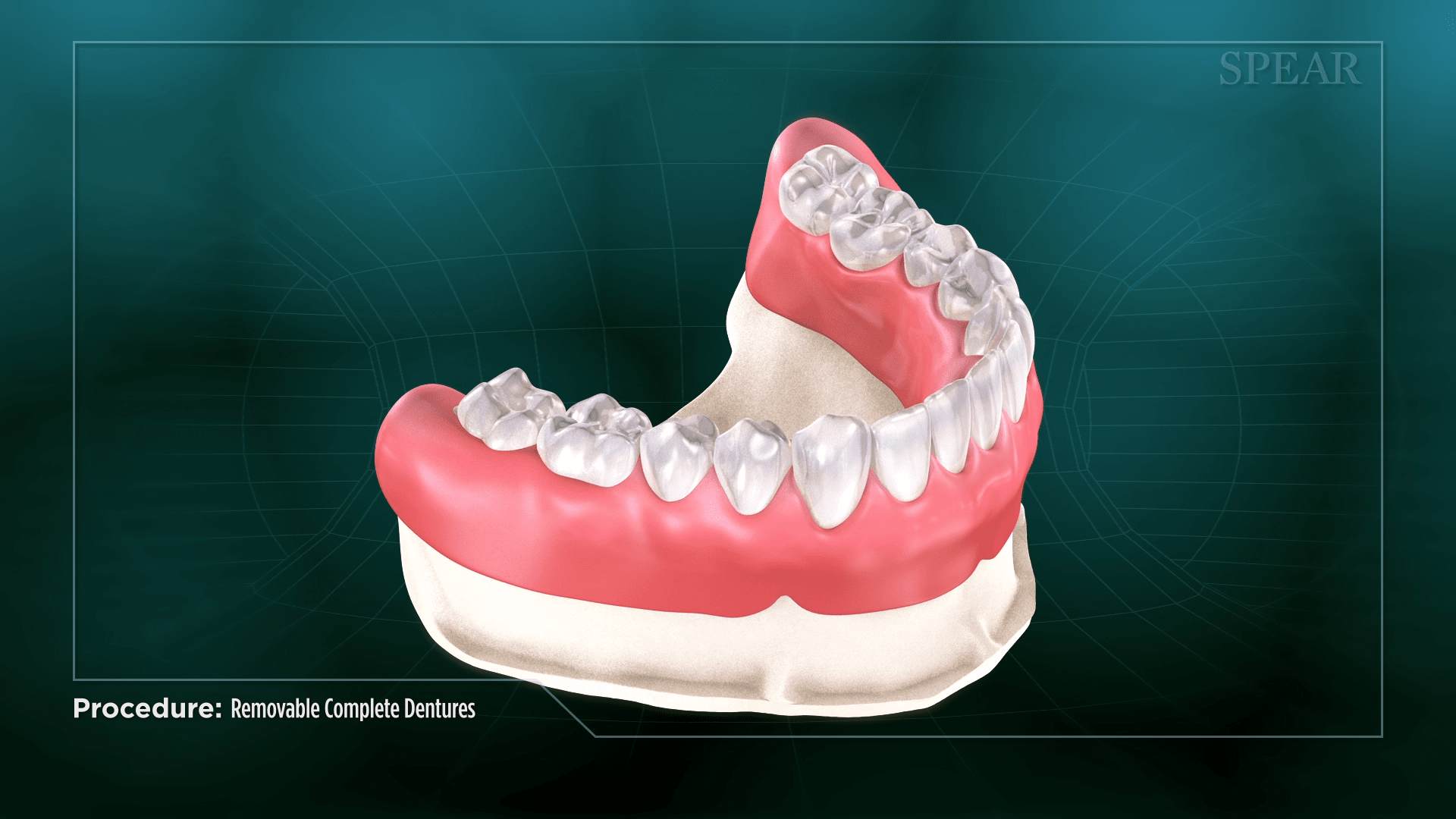 Mouth Prosthesis Design at SmileMore Dental