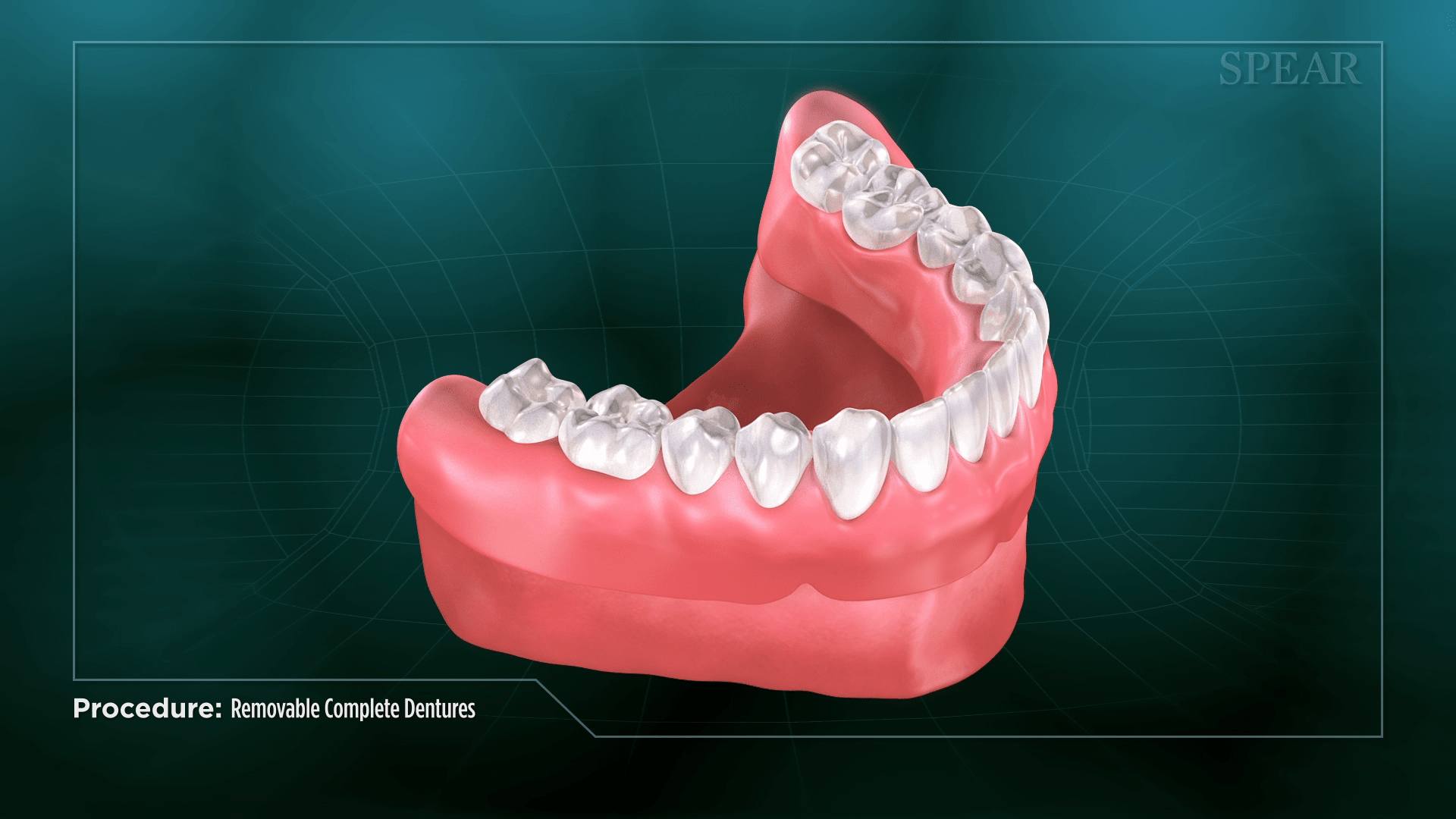 Prosthesis Alignment Check at SmileMore Dental